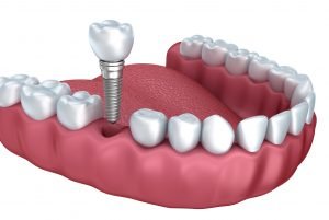 single tooth implants