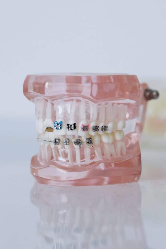 Doctors office in Deerfield Beach, FL showing how braces work on teeth