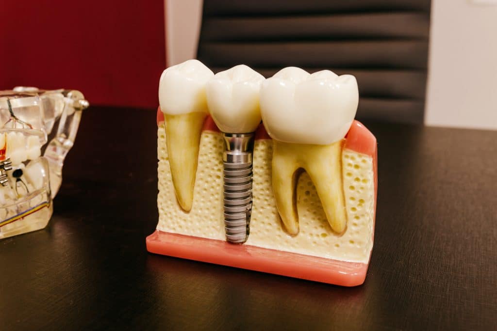 Dentist office in Brandon Florida show tooth decay restoration