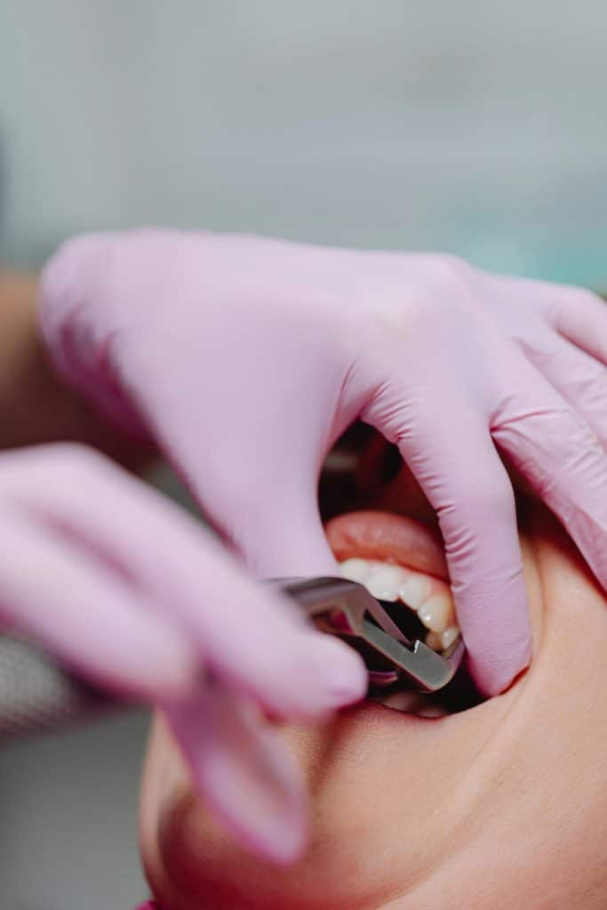 tooth extraction from sage dental