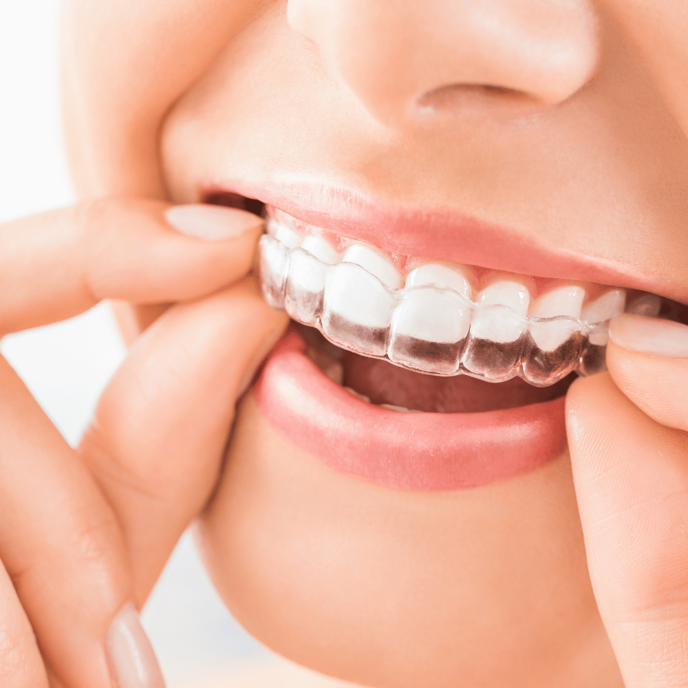 Clear Aligners image