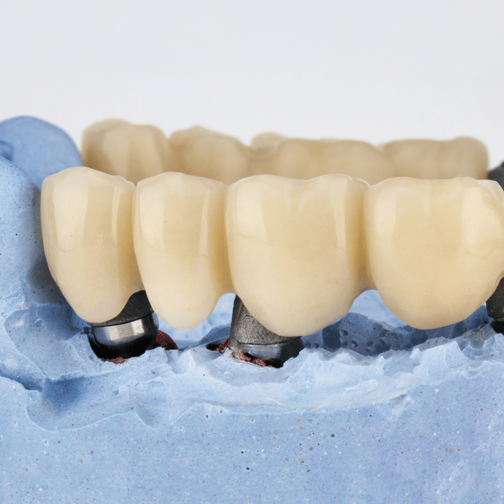 Crowns & Bridges image