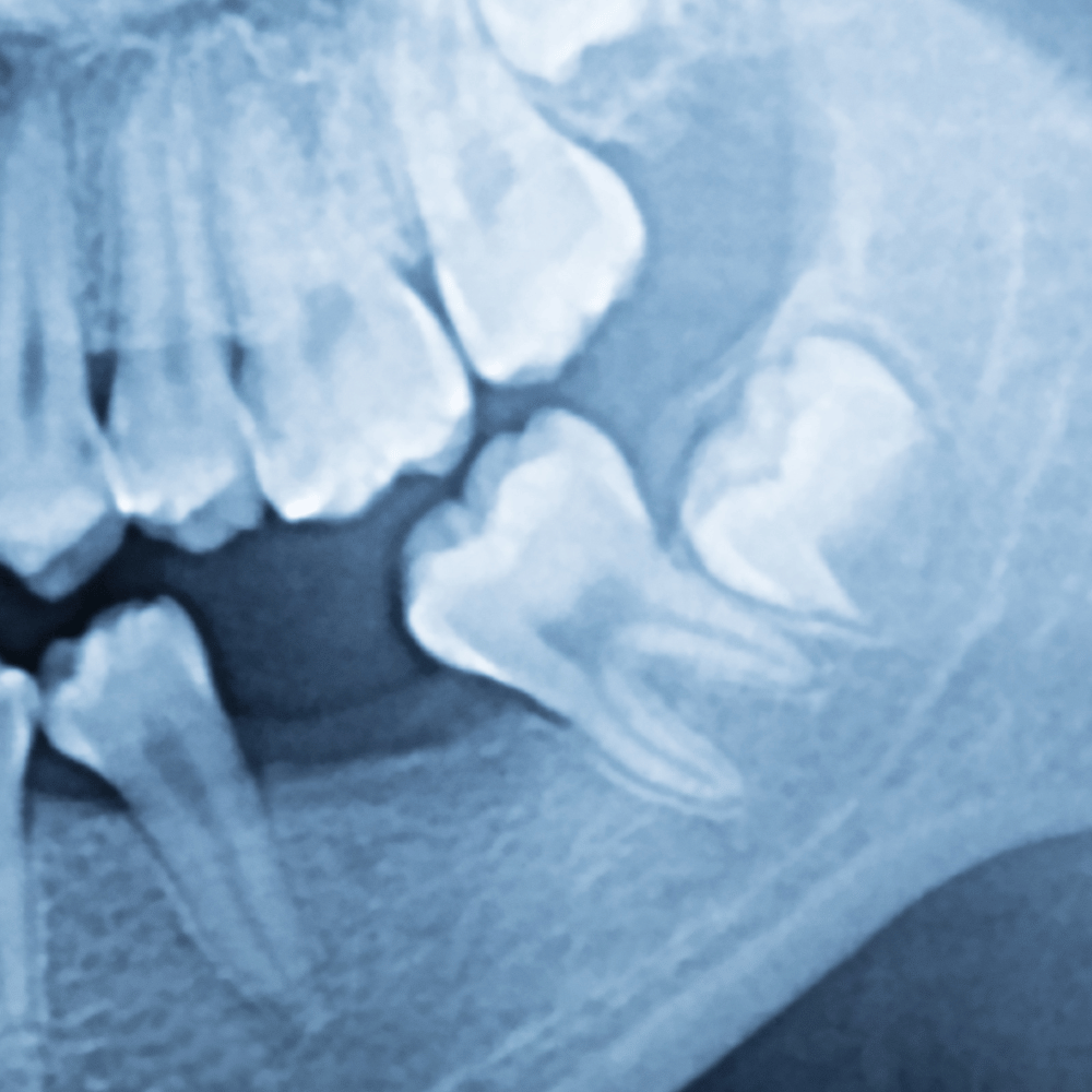 Digital X-rays teeth