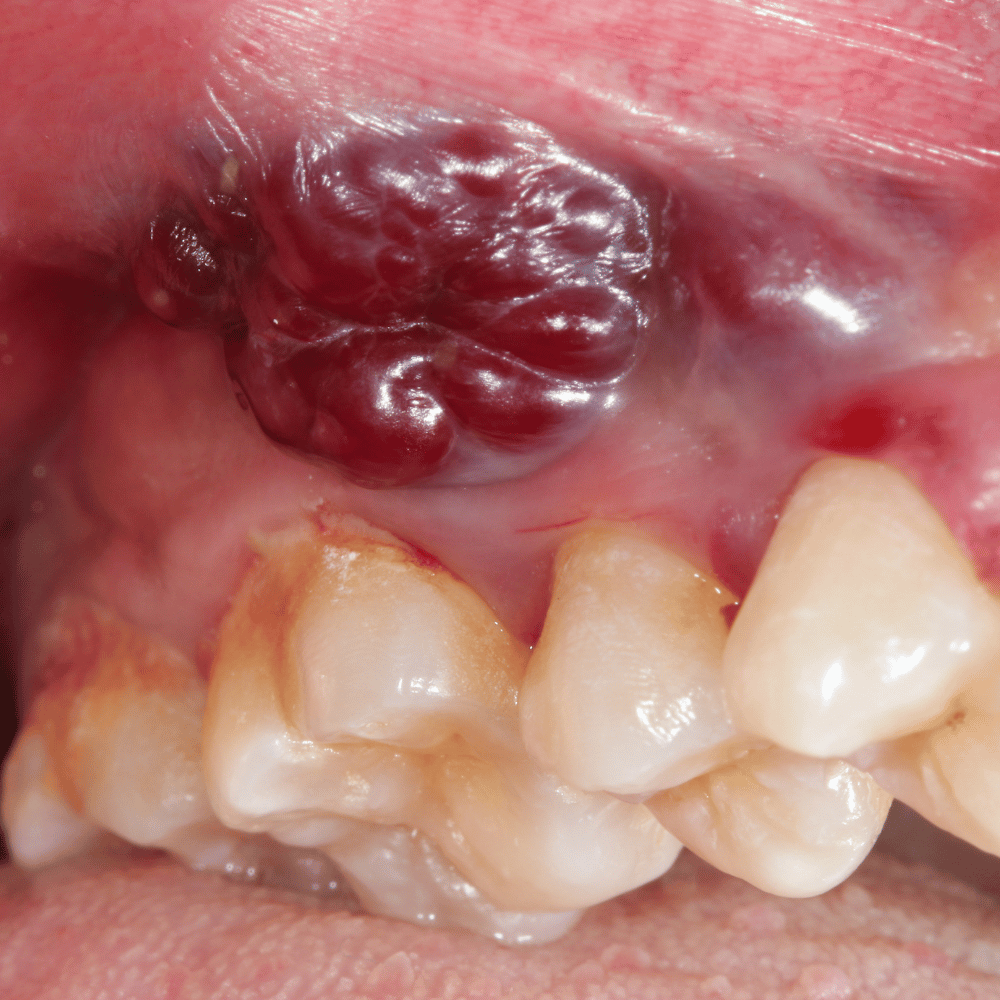 Oral Cancer Evaluations image