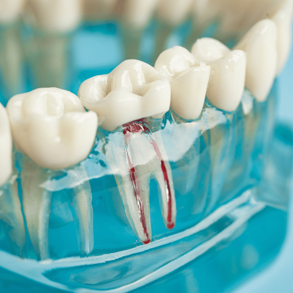 Root Canal image